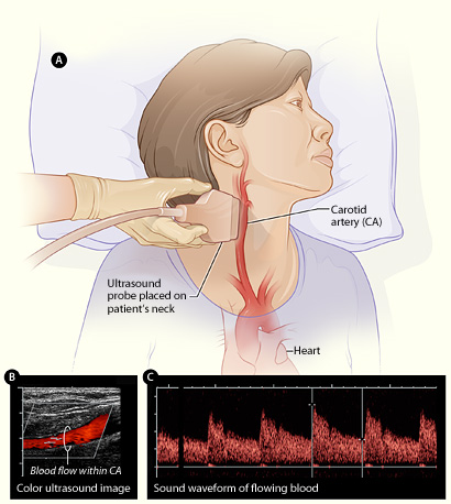 Ultrasonido Doppler de carótidas