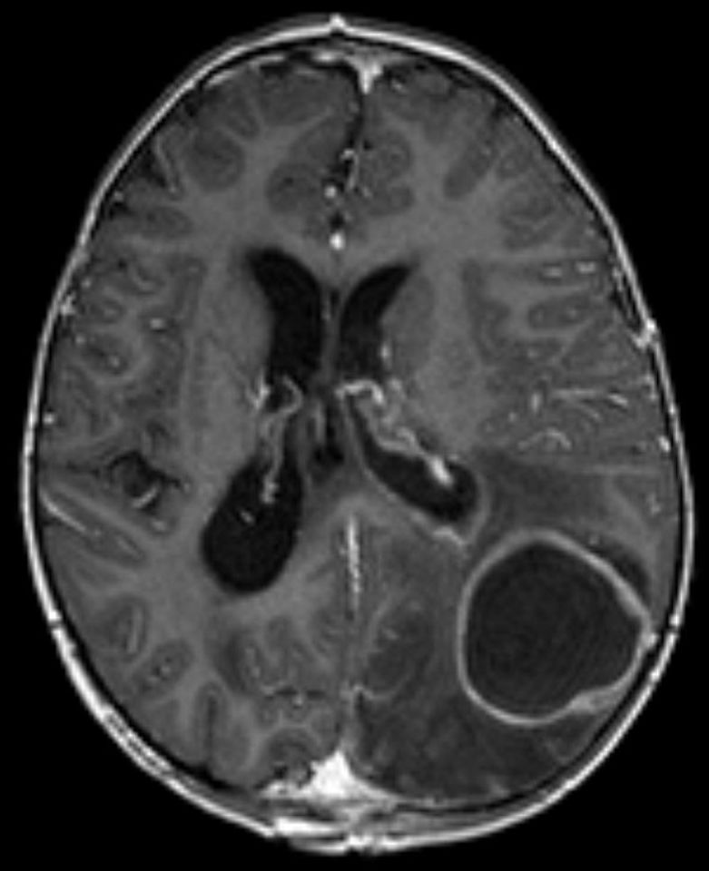 Absceso cerebral