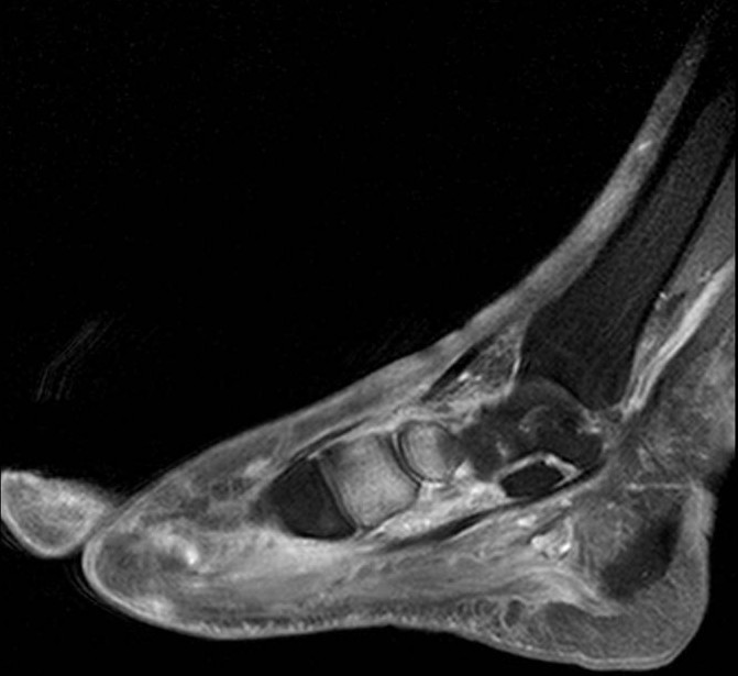 Artropatía neuropática del pie (pie de Charcot)