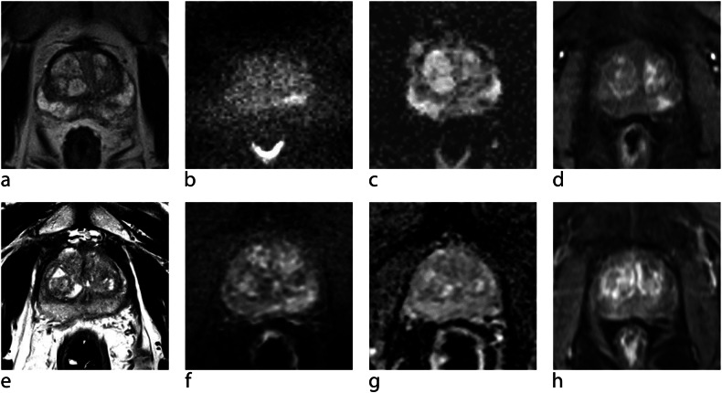 Cáncer de próstata en resonancia multiparamétrica