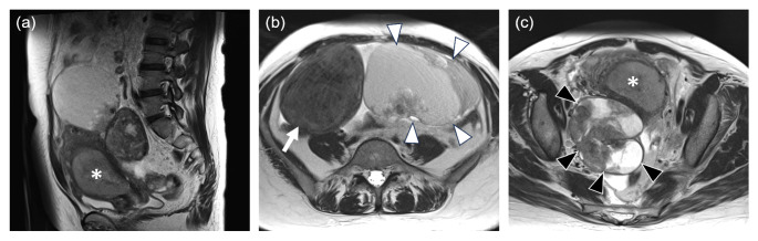 Carcinoma de endometrio