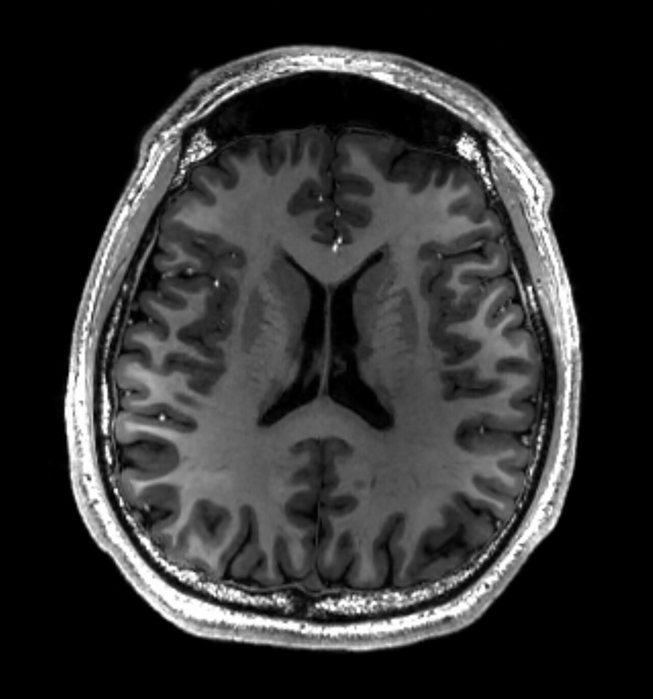 Resonancia magnética cerebral