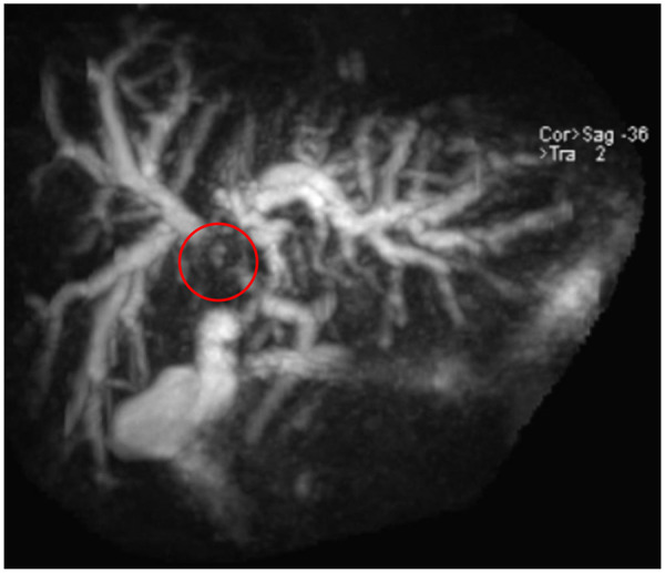 Colangiocarcinoma hiliar