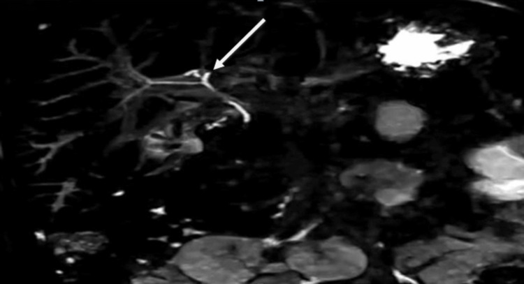 Colangitis esclerosante primaria