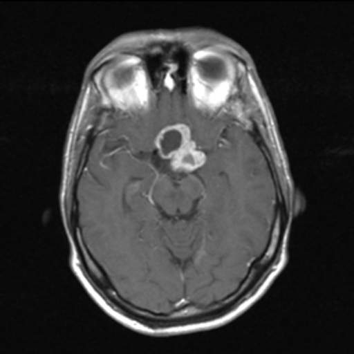 Craneofaringioma