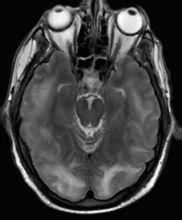 Síndrome de encefalopatía posterior reversible