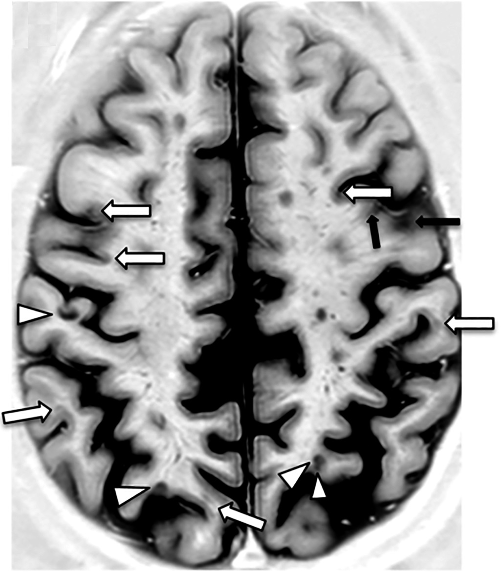 Esclerosis múltiple