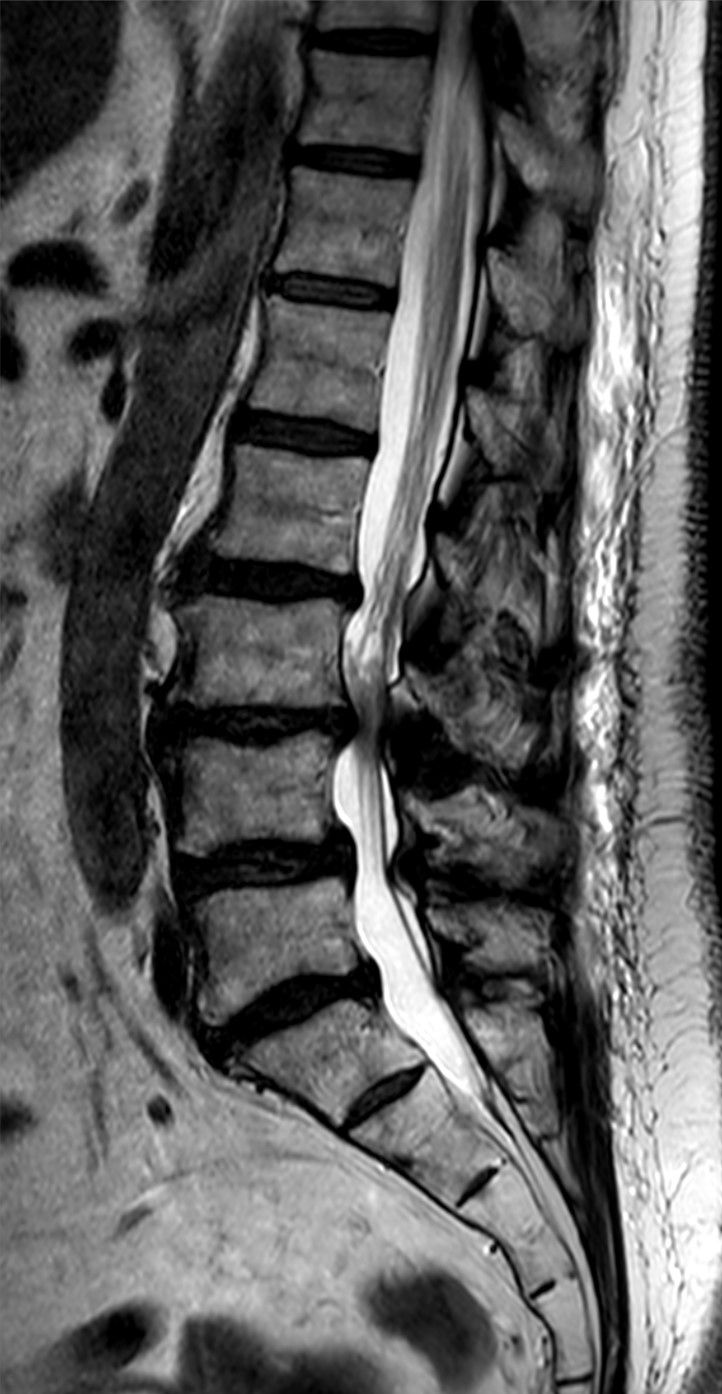 Estenosis del canal lumbar