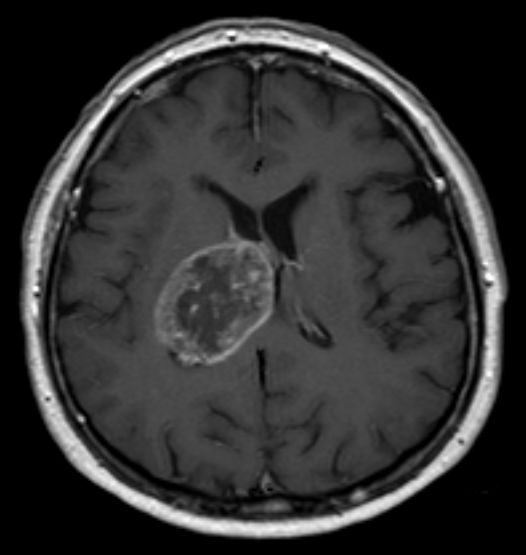 Glioblastoma