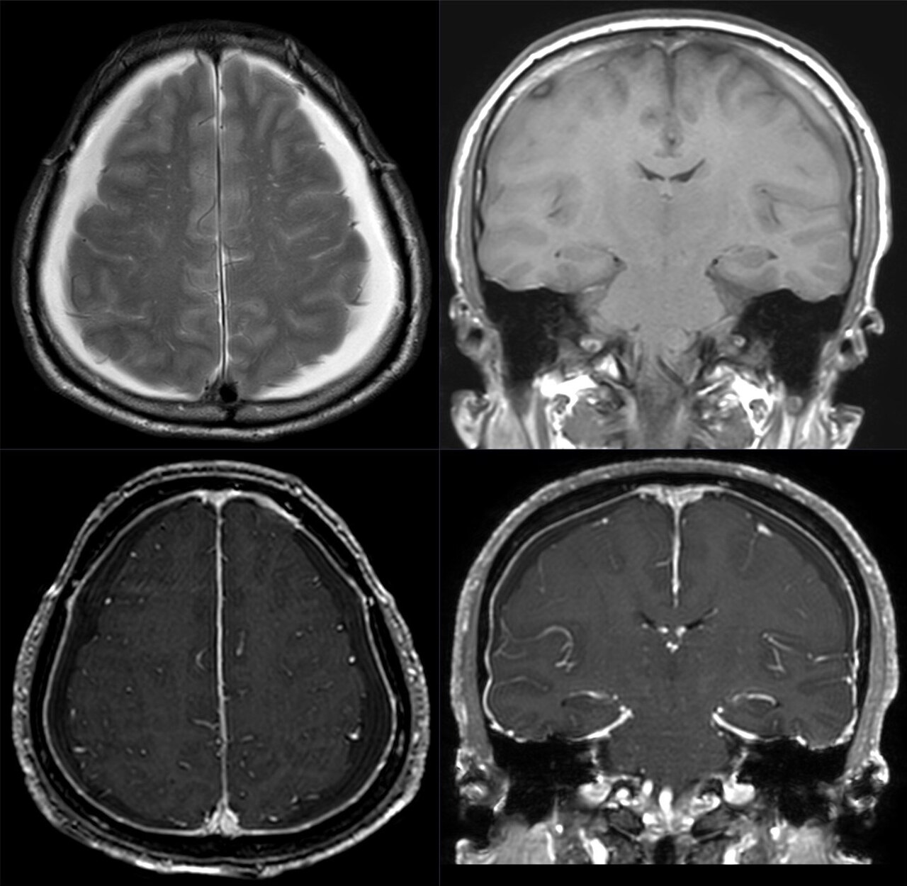 Hipotensión intracraneal espontánea