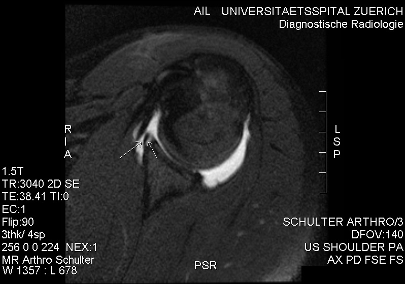 Lesión del labrum glenoideo tras luxación de hombro