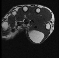 Lipoma de partes blandas