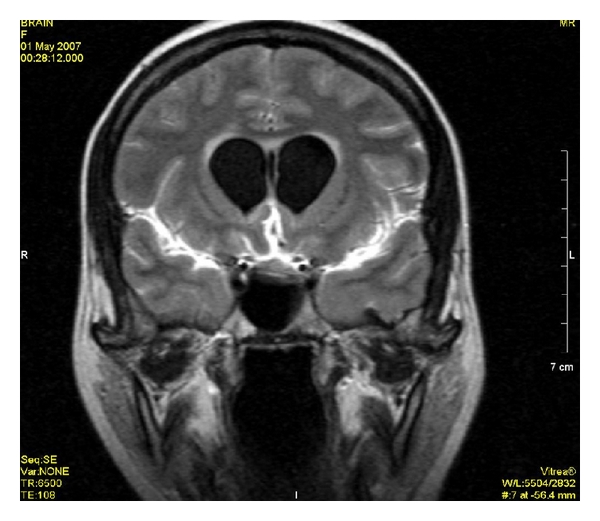 Meningitis aguda y sus complicaciones