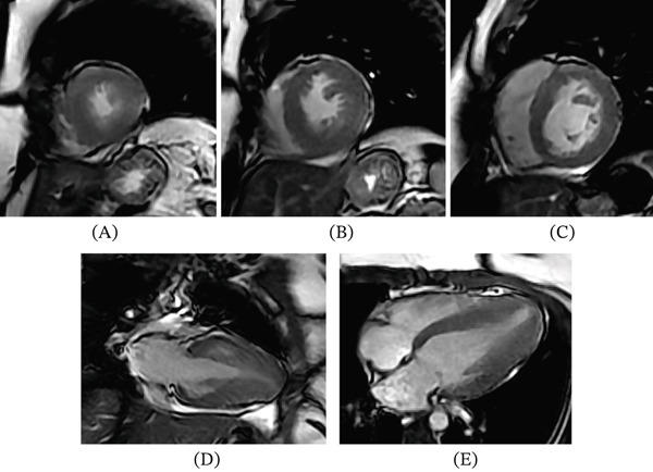 Miocardiopatía hipertrófica