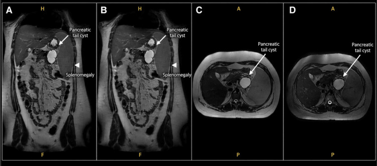 Neoplasias quísticas del páncreas
