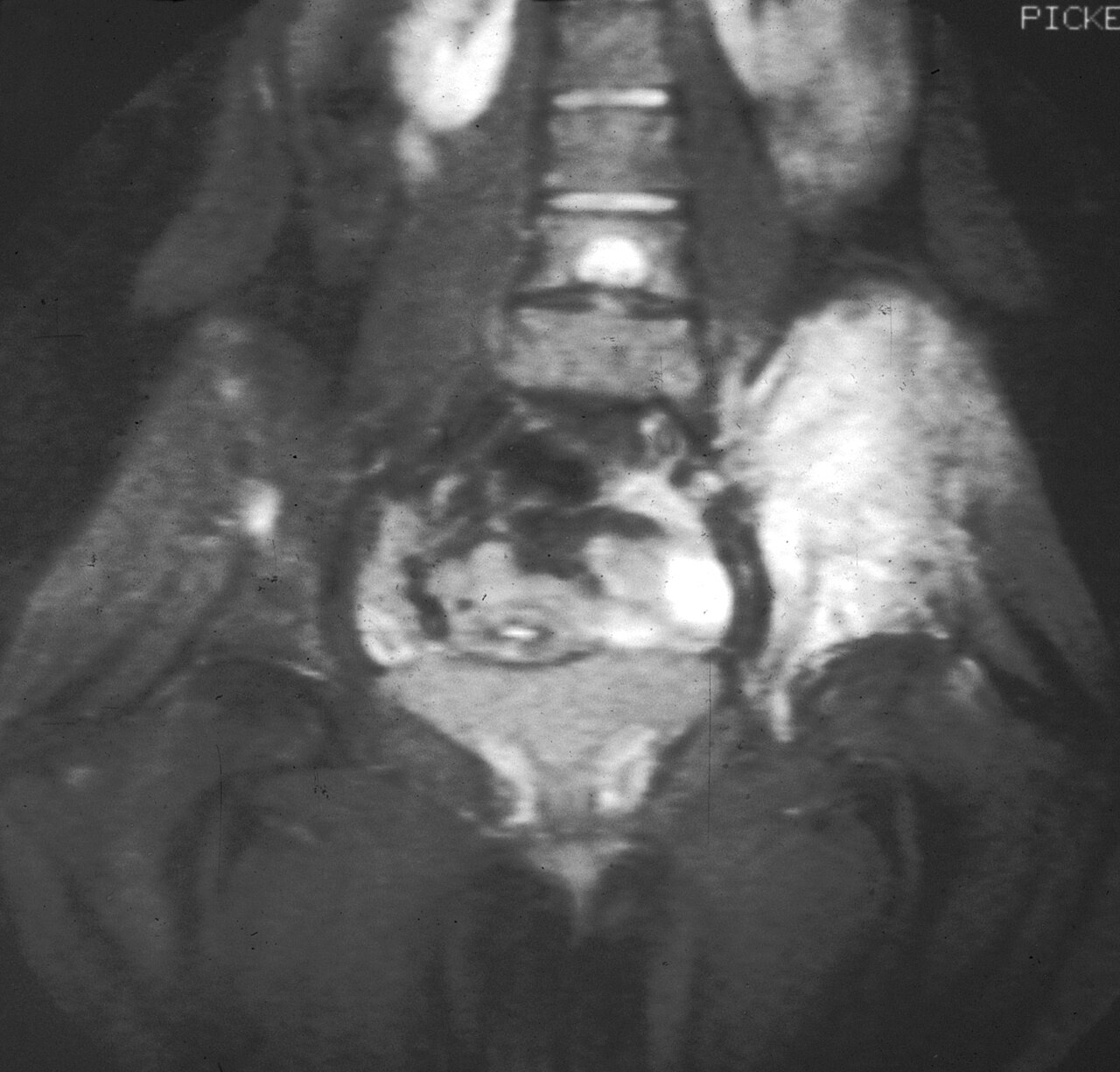 Sarcoma de Ewing