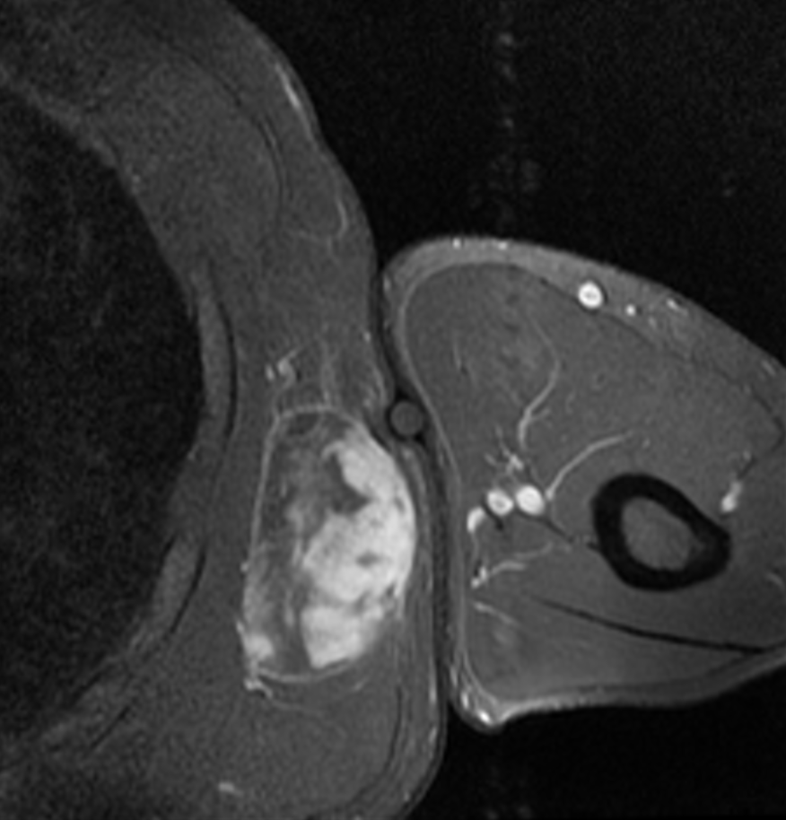 Sarcoma de partes blandas