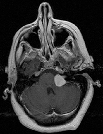 Schwannoma vestibular