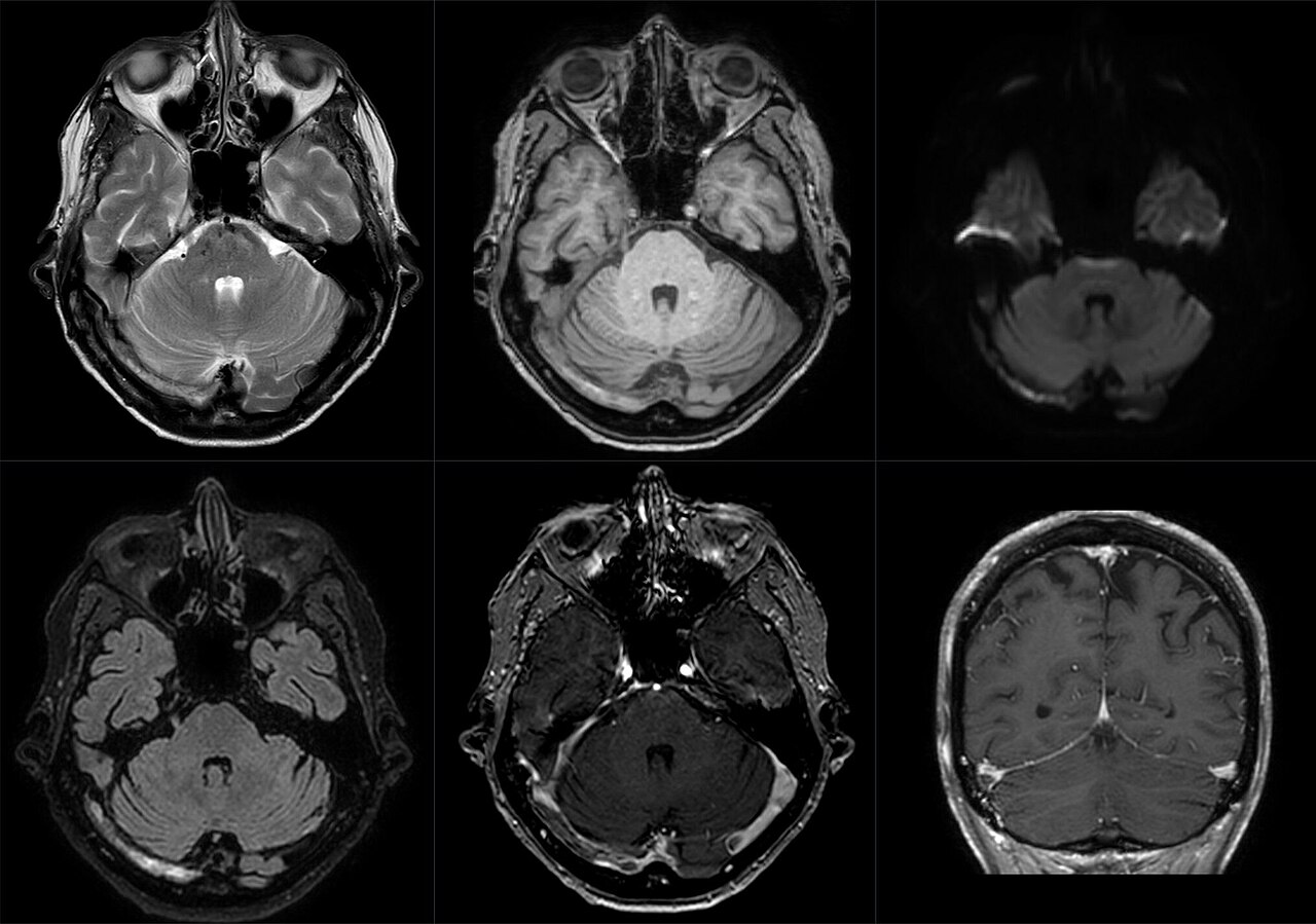 Trombosis venosa cerebral