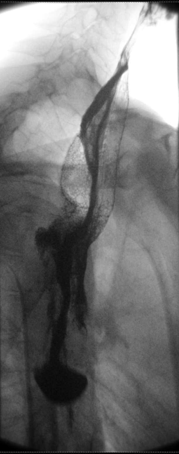 Acalasia