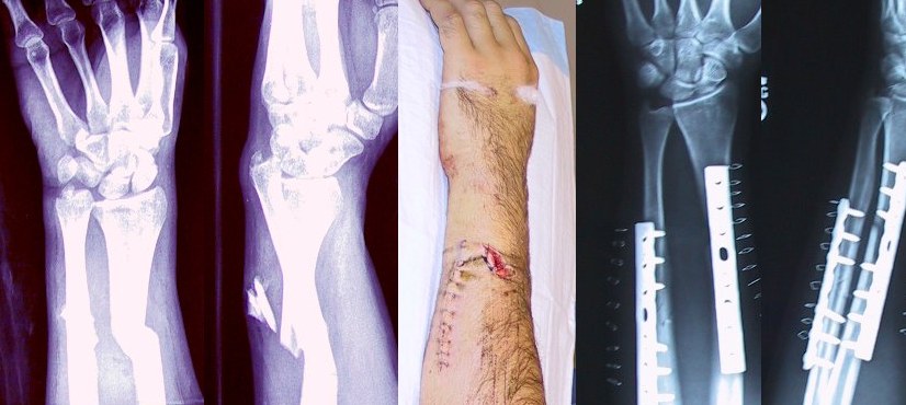 Osteosíntesis de antebrazo (control postquirúrgico)