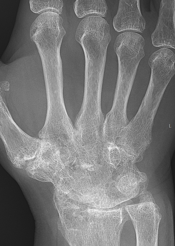 Artritis reumatoide