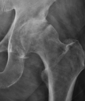 Artrosis de cadera (coxartrosis)