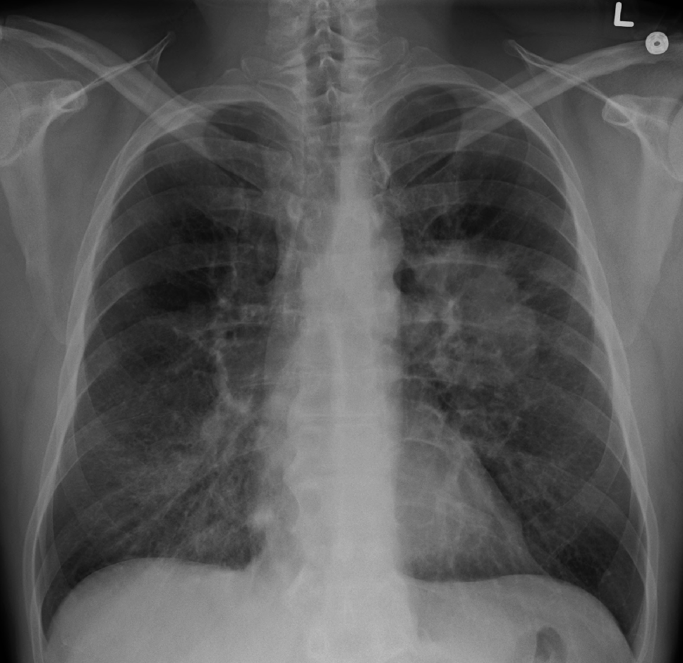 Nódulo y masa pulmonar (cáncer de pulmón)