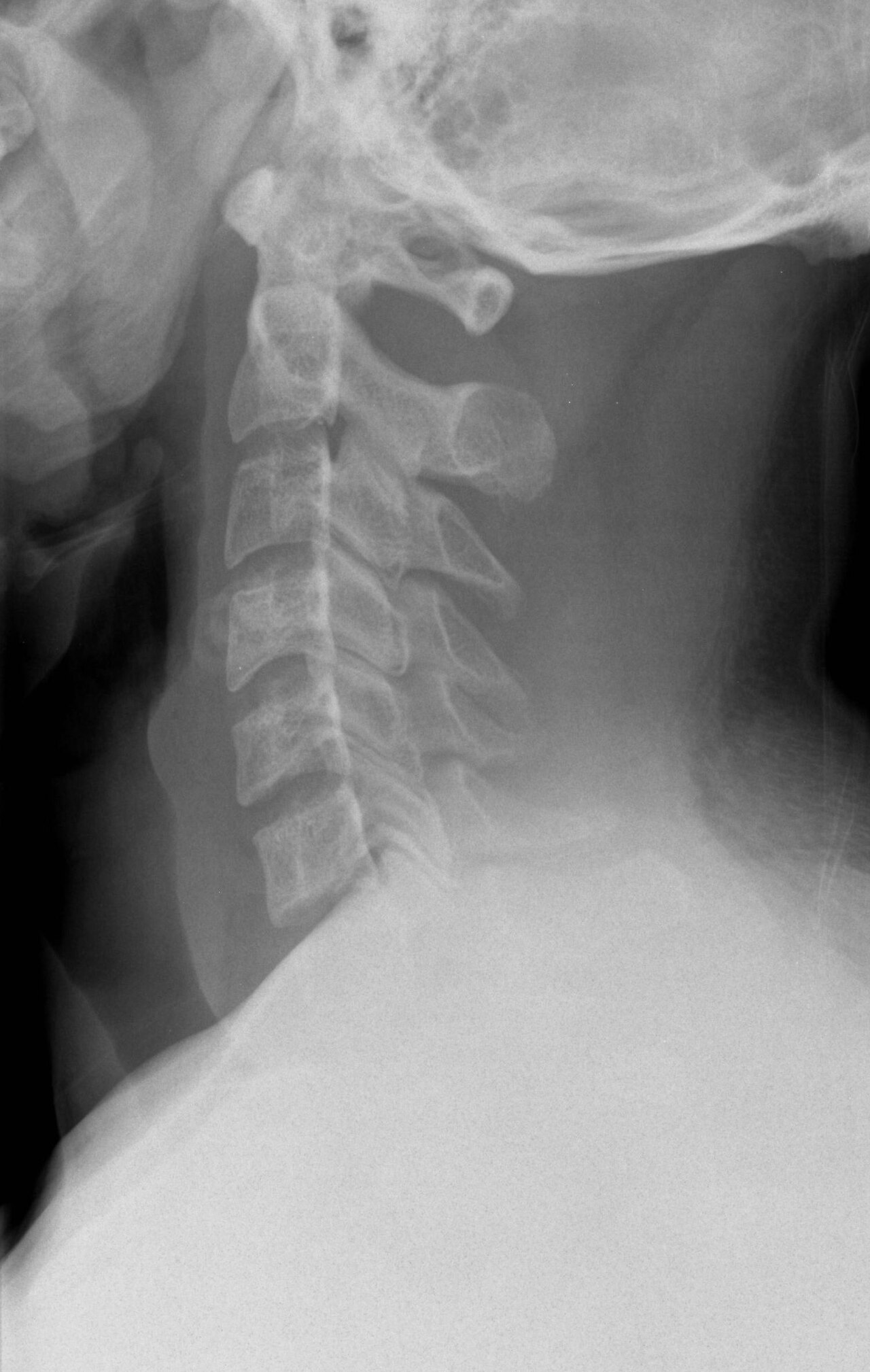 Radiografía lateral de columna cervical