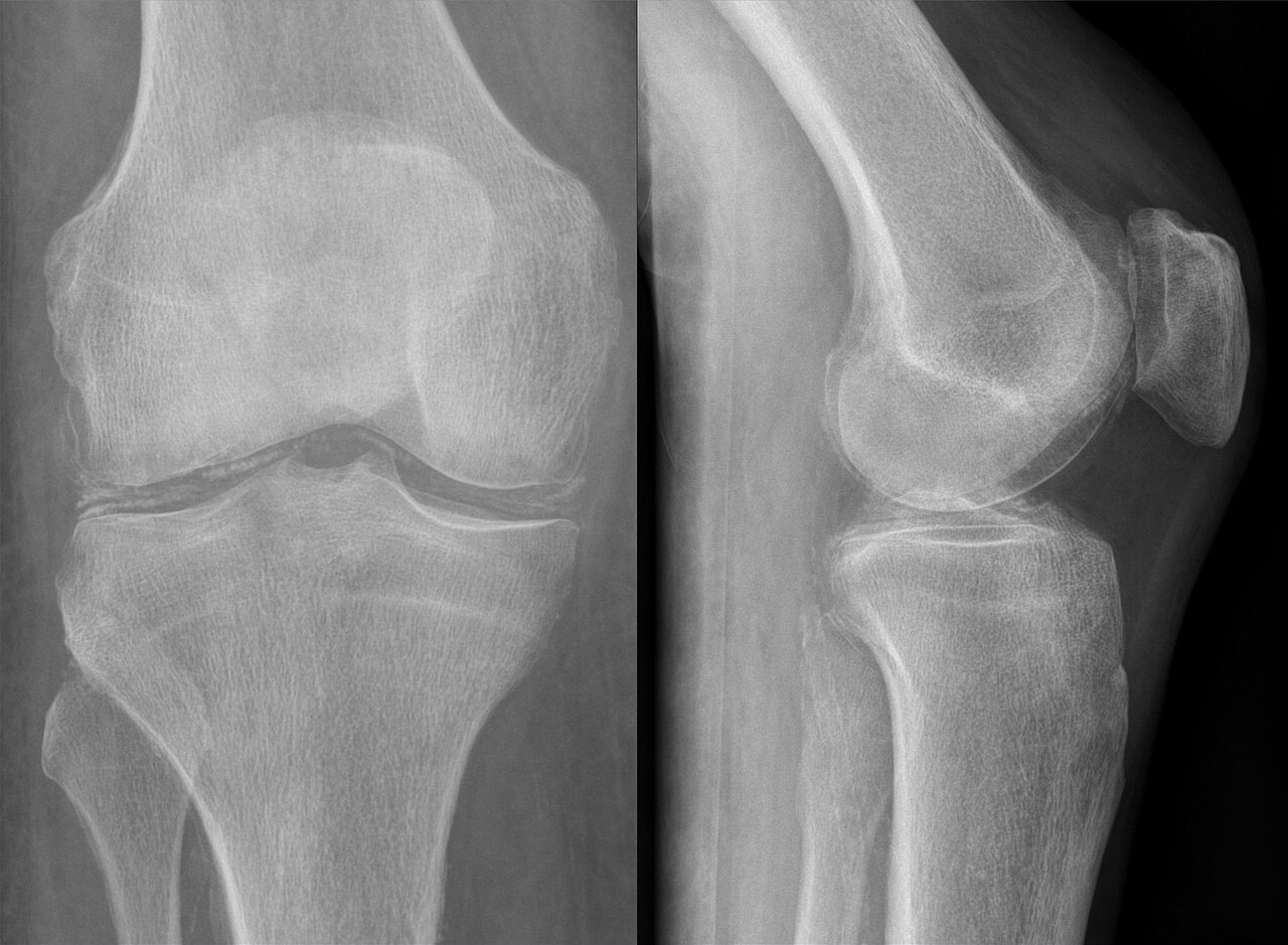 Condrocalcinosis y artropatía por depósito de pirofosfato