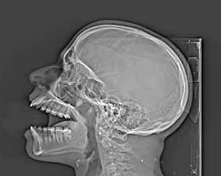 Radiografía lateral de cráneo