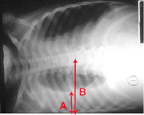 Derrame pleural