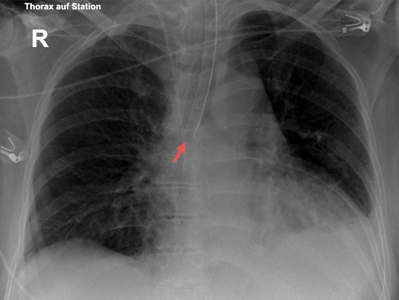 Dispositivos en la radiografía de tórax del paciente crítico