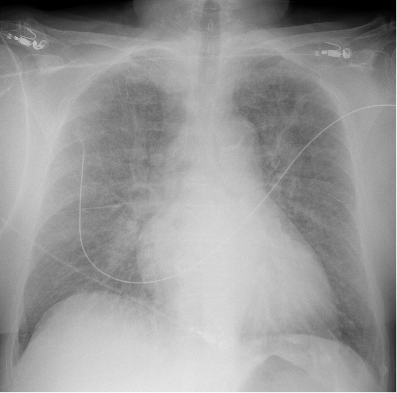 Edema pulmonar cardiogénico