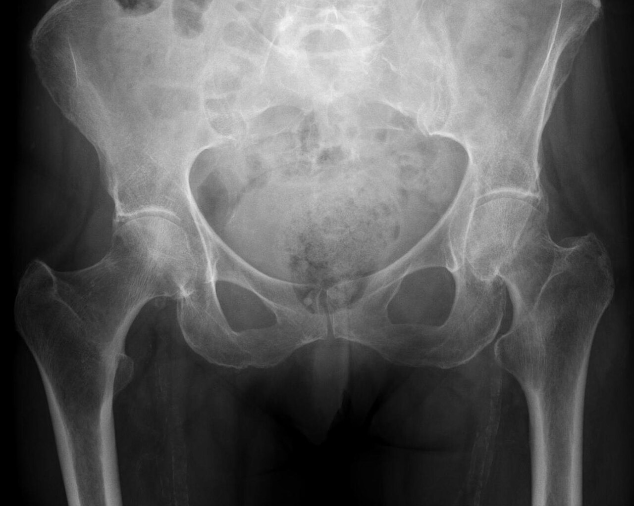 Fractura de cadera (cuello femoral y pertrocantérea)