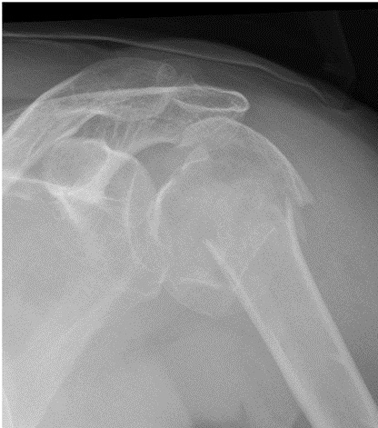 Fractura del húmero proximal