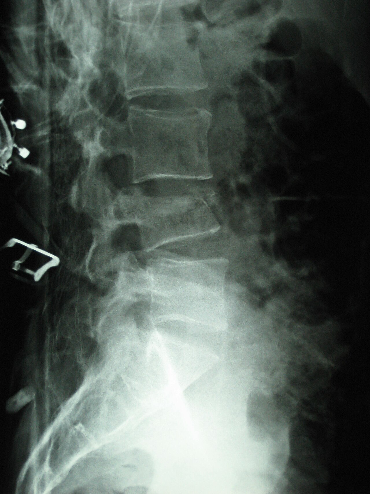 Fractura vertebral osteoporótica