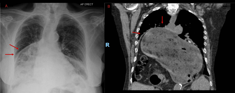 Hernia hiatal