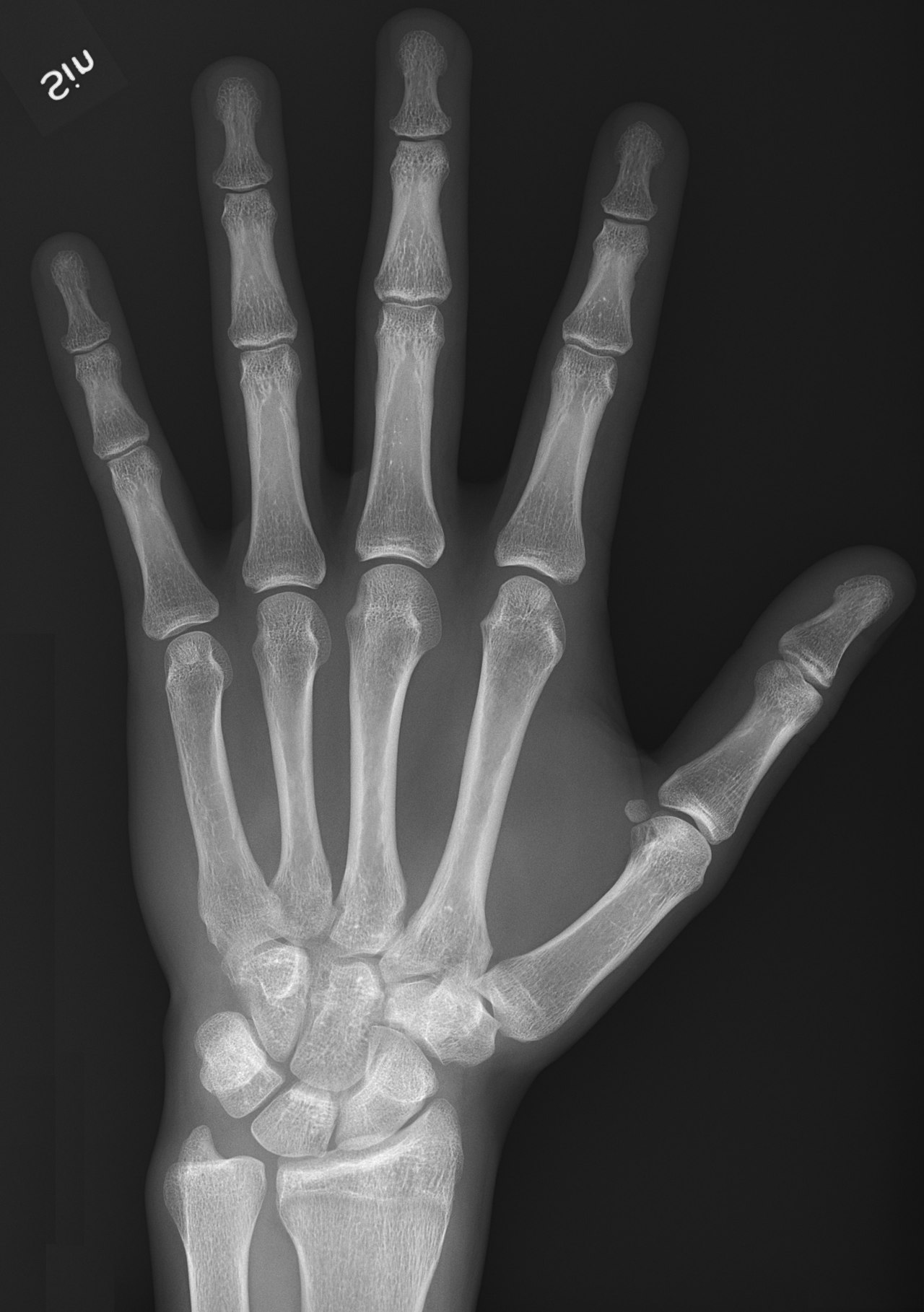Radiografía de mano normal (dorsopalmar)