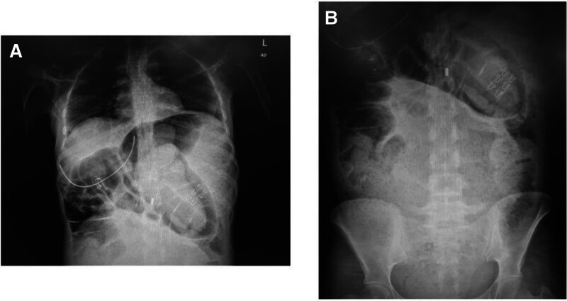 Megacolon tóxico