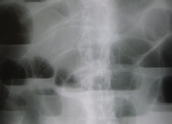 Obstrucción intestinal