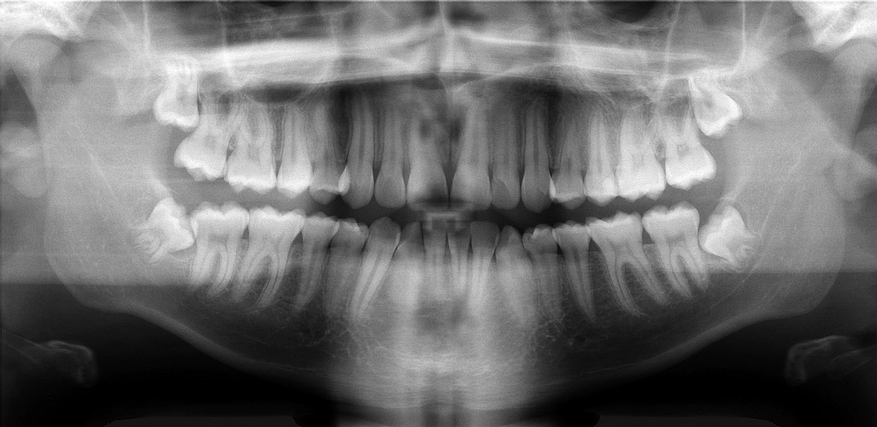 Ortopantomografía (radiografía panorámica dental)