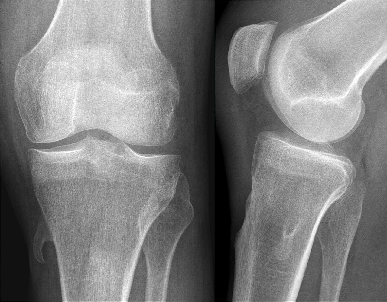 Osteocondroma (exostosis osteocartilaginosa)