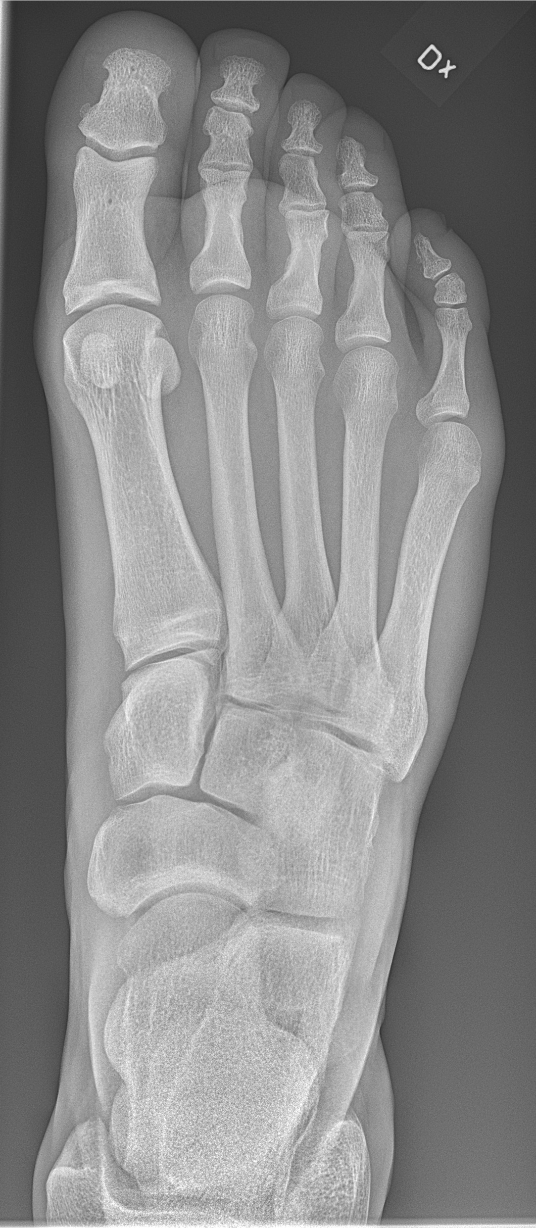 Radiografía de pie normal (dorsoplantar)