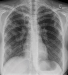 Tuberculosis pulmonar