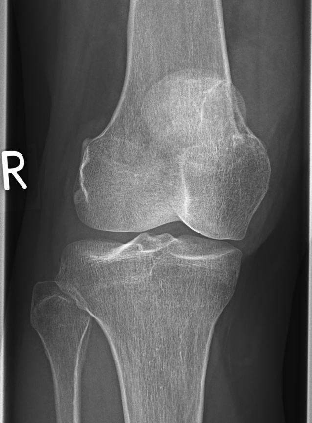Tumor óseo de células gigantes