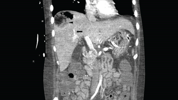Absceso hepático piógeno
