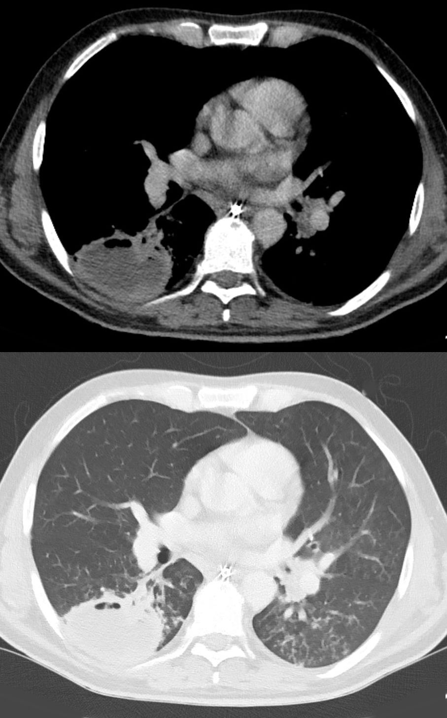 Absceso pulmonar