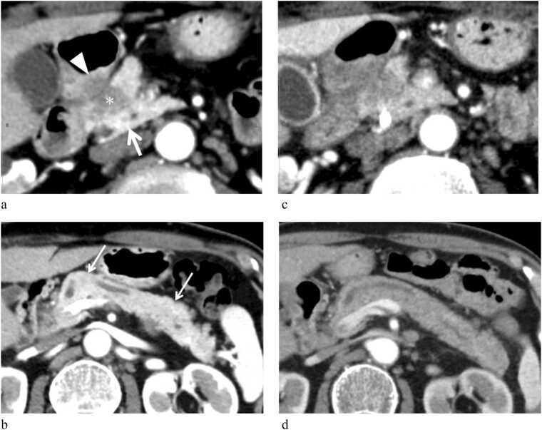 Adenocarcinoma de páncreas