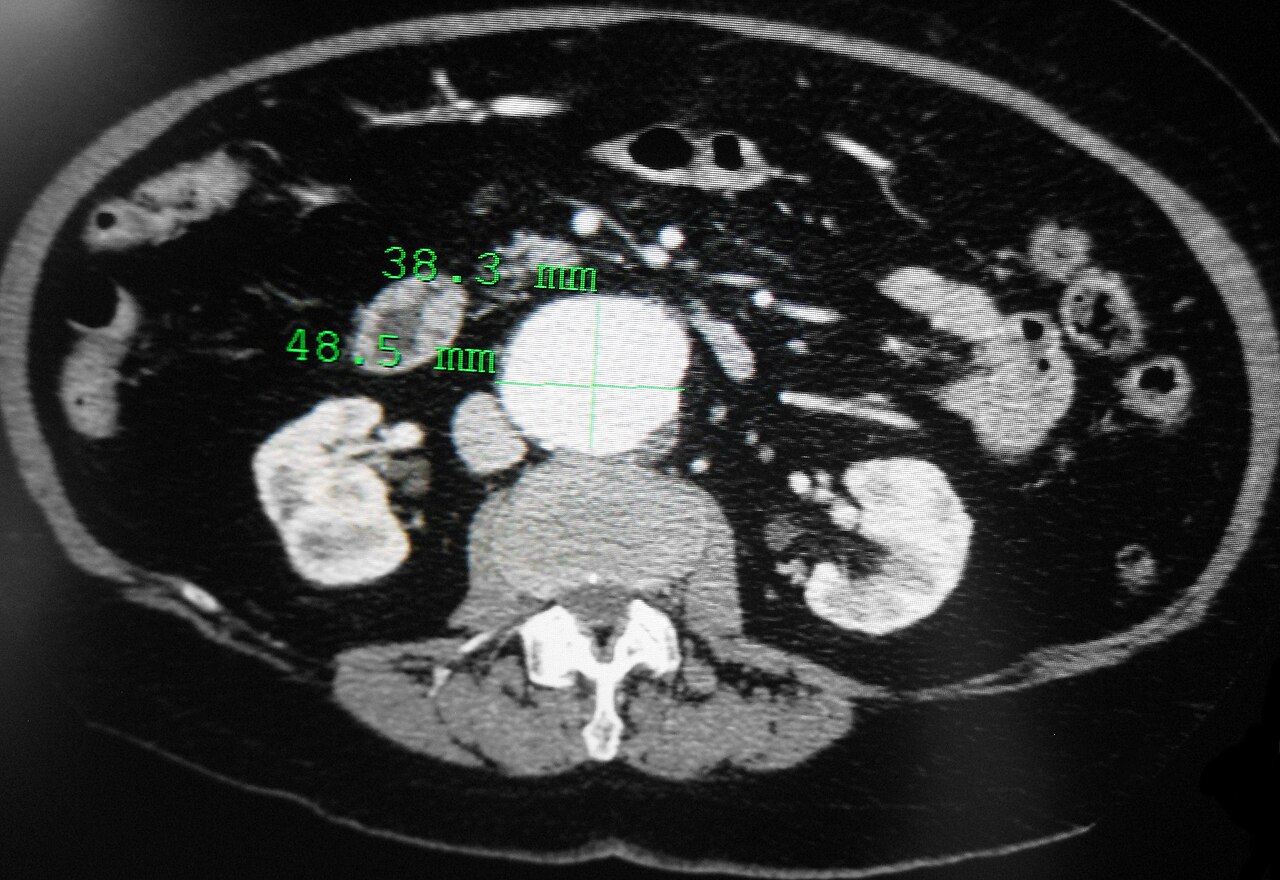 Aneurisma de aorta abdominal